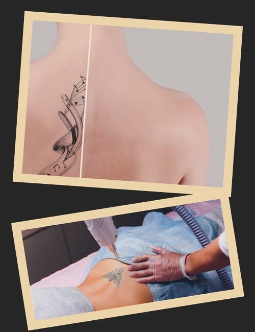 Переваги лазерної обробки тату