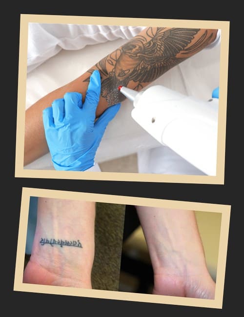 видалення тату в салонах Києва