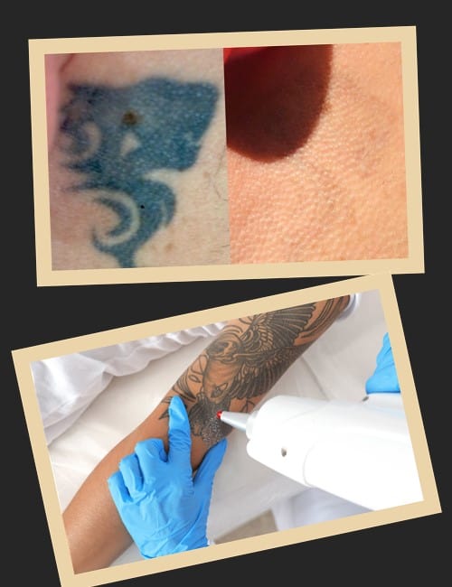 видалити тату без шраму