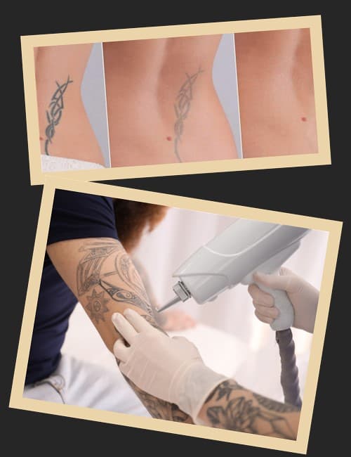 Лазерне виведення татуювань – безпечна процедура