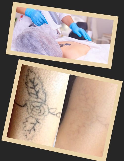 Лазерне виведення татуювань – ефективний метод