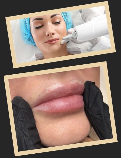 Як вивести татуаж губ?