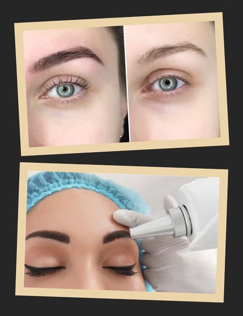 Причини видалення татуажу брів