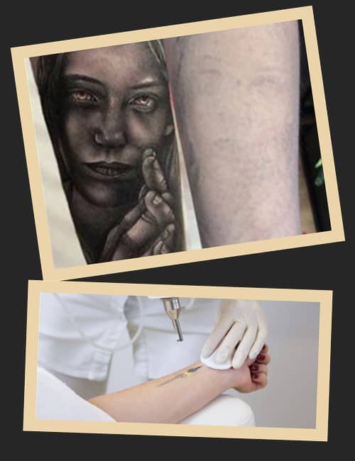 Методи видалення татуювань