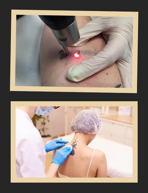 Основні методи виведення тату