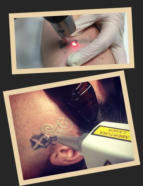 лазер для видалення татуювань