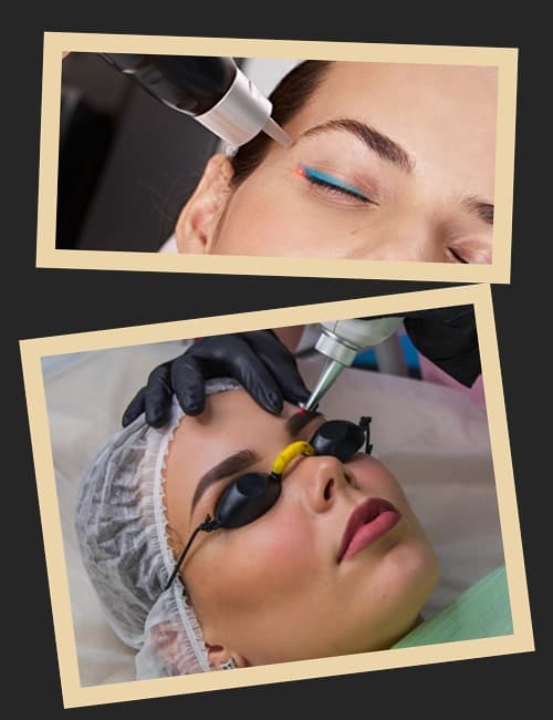 Які методи підходять для видалення татуажу