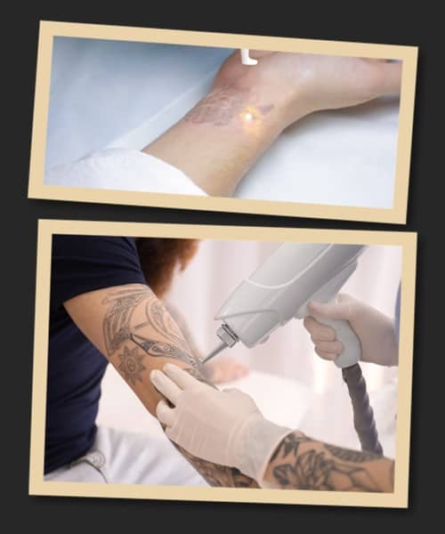 Причини видалення тату