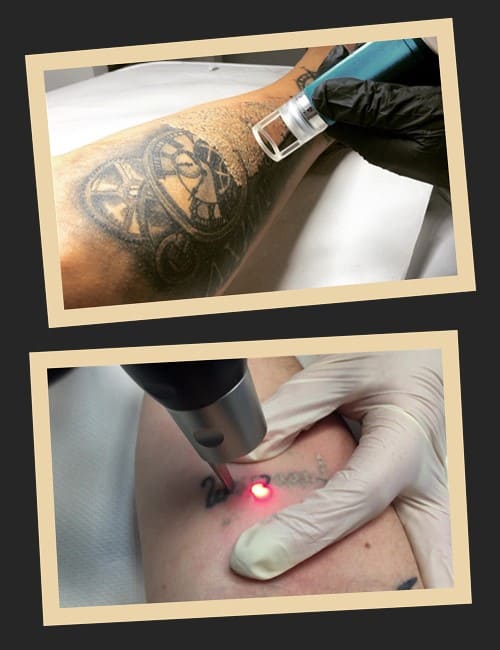 Способи видалення тату