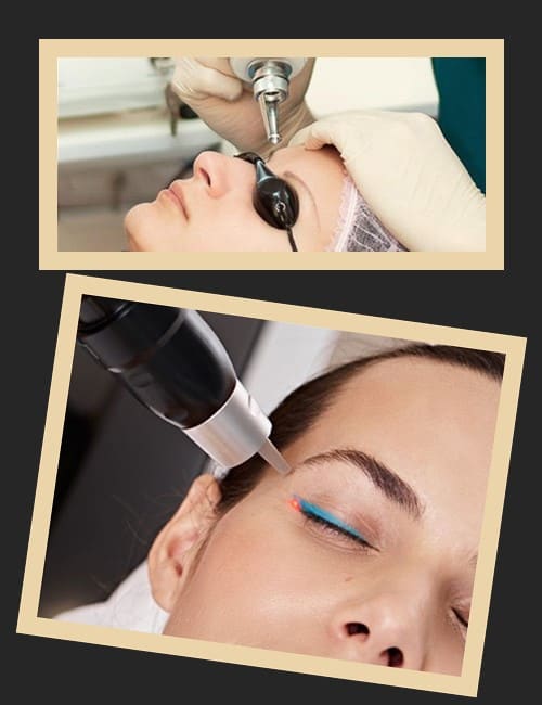 Процедура виведення татуажу лазером