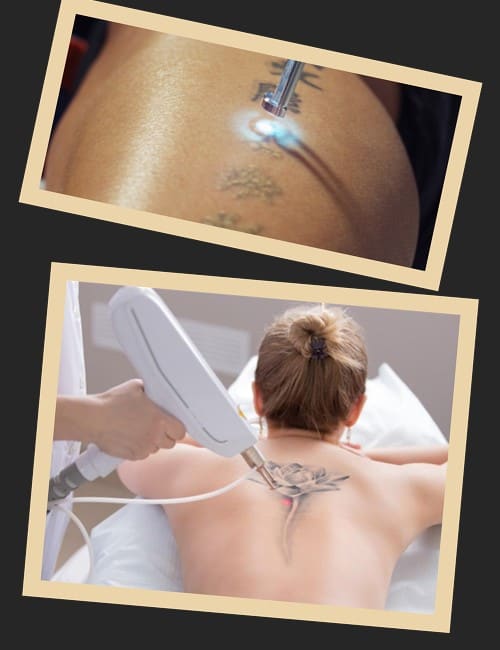 Лазерний спосіб зведення тату
