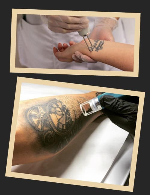 Найсучасніший і найбезпечніший лазер для видалення татуювань