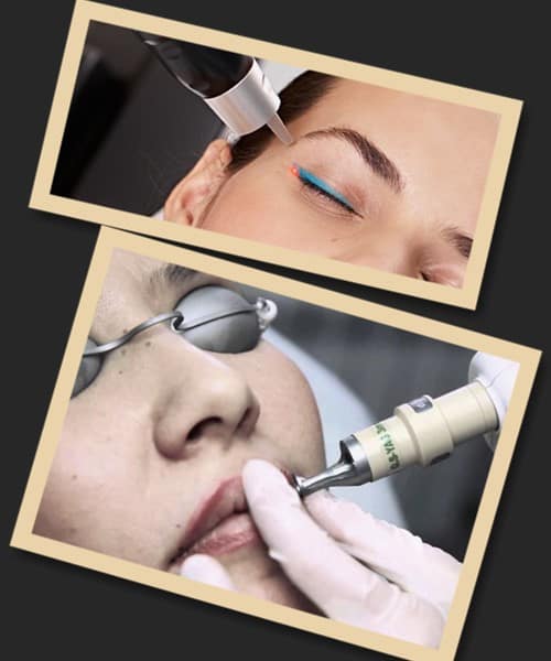 Чому лазерне видалення – найкраще