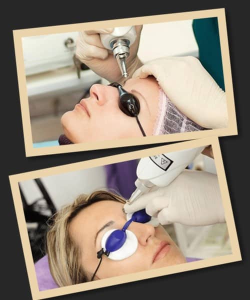 Переваги виведення татуажу брів лазером