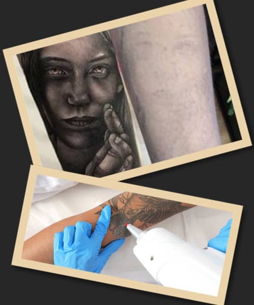 Лазерний спосіб зведення тату