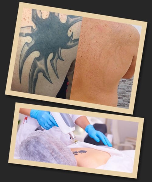 Основні методи очищення шкіри від тату