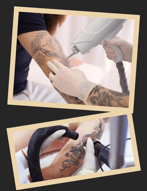 Існуючі методи видалення тату