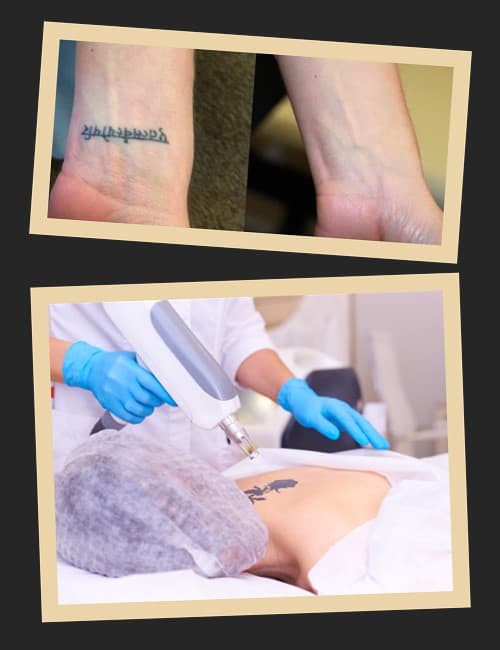 Лазерний спосіб вивести тату