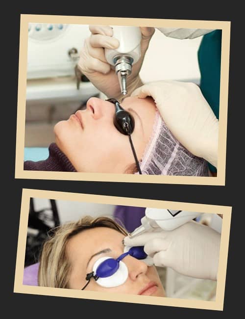 видалити татуаж лазером