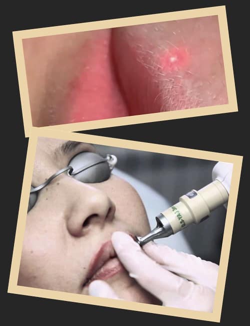 Вивести татуаж губ лазером