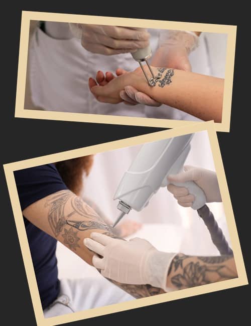 Особливості лазерного методу видалення тату