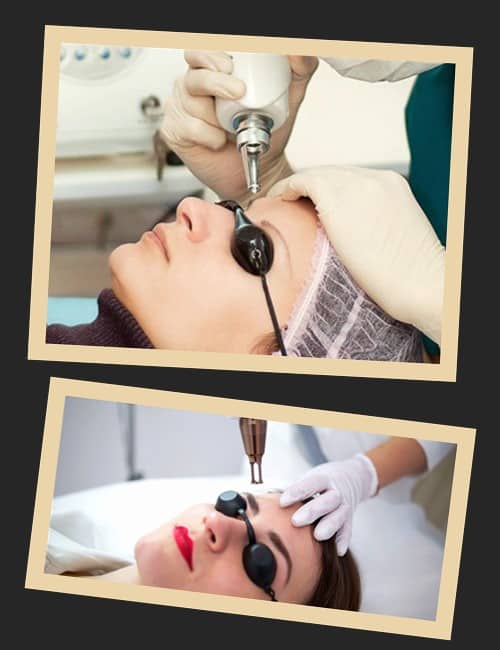 Особливості процедури лазерного видалення татуажу