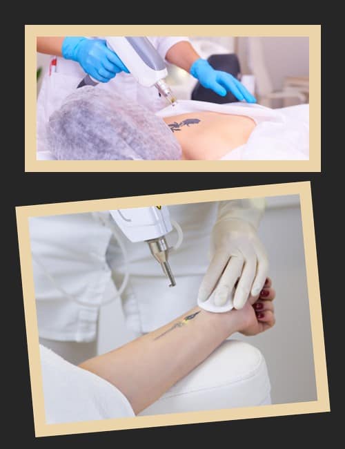 Якими бувають лазери для видалення тату