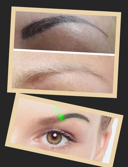 У чому особливості лазерного методу