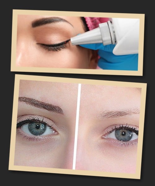 идалення перманентного пігменту з повік