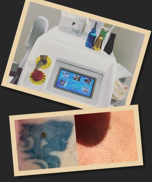 Метод виведення тату лазером