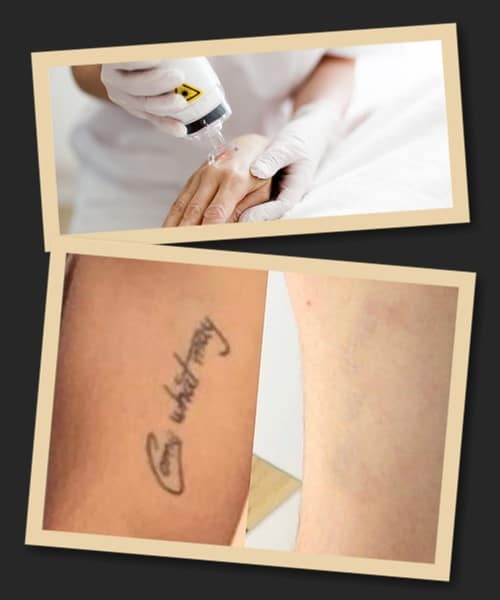 Лазерне видалення тату