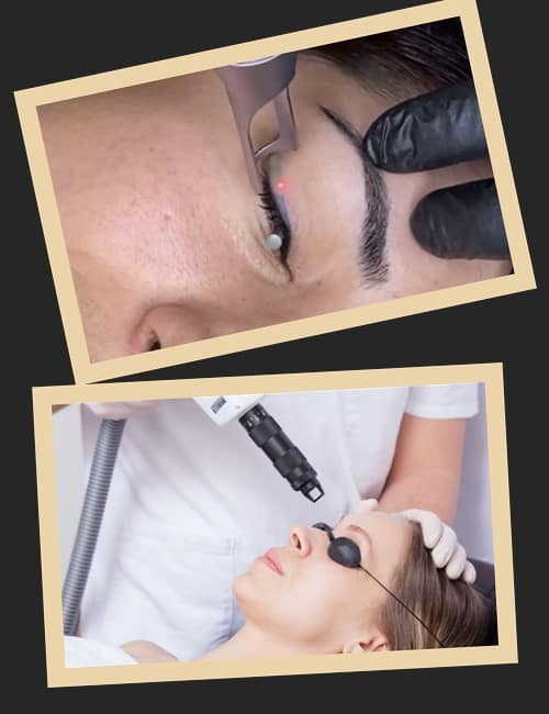 видалення татуажу очей лазером