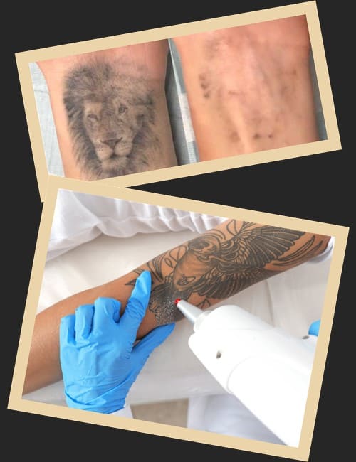 тип лазера – неодимовий, допомагає вивести тату