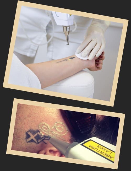 Лазерне видалення татуювань має ряд переваг