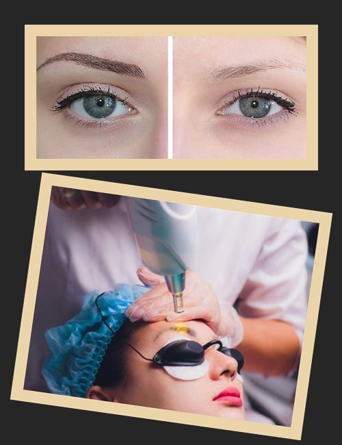 лазерне видалення перманенту брів