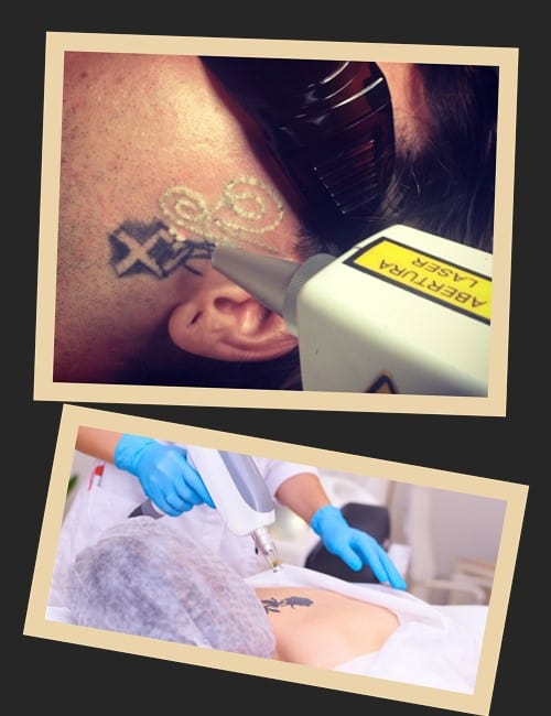 як звести татуювання