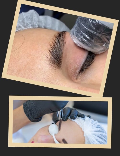 Як проходить лазерне видалення татуажу