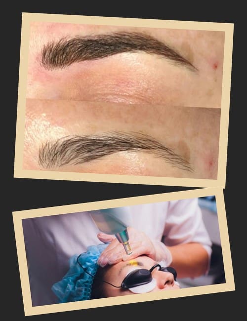 хімічний та лазерний методи виведення татуажу