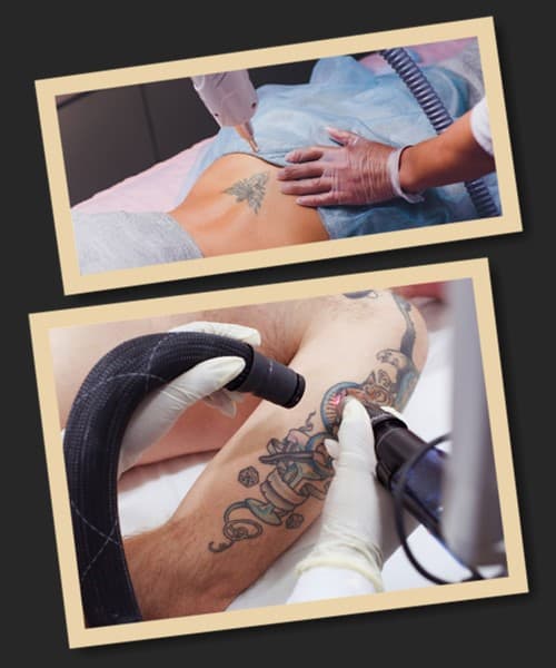 Суть лазерного видалення тату