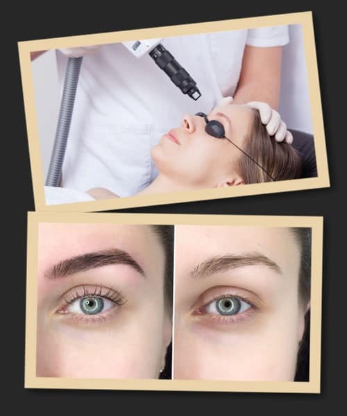 Видалення татуажу лазером