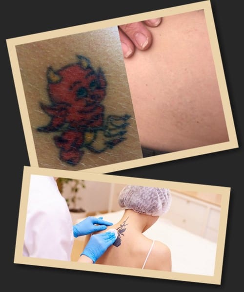 Видалення татуювань із застосуванням сучасних лазерів