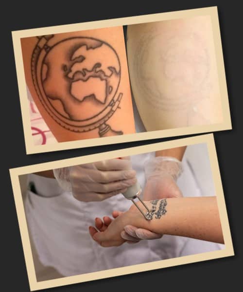 Видалення перманентного малюнка з тіла