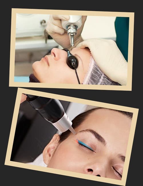 Видалення татуажу очей лазером – безпечна процедура