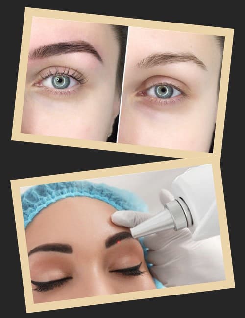 Позбавлення від невдалого татуажу брів за допомогою лазера