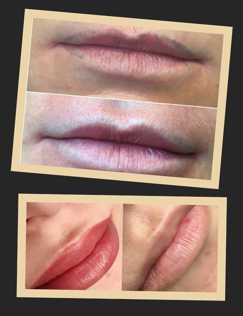 видалення лазером татуажу губ