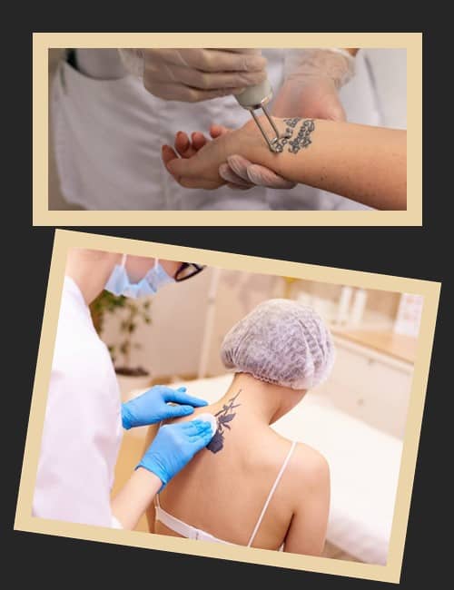 Переваги лазерного методу видалення тату