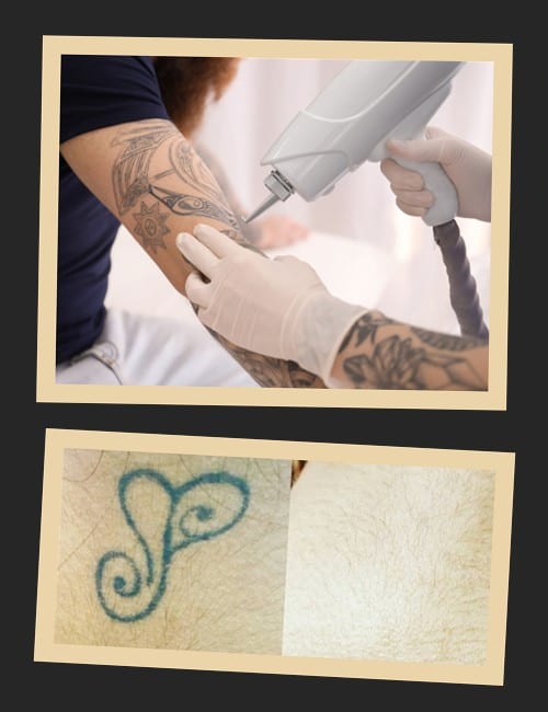 Оптимальний результат при виведенні татуювання