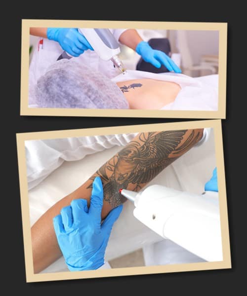 протипоказання до лазерного зведення тату