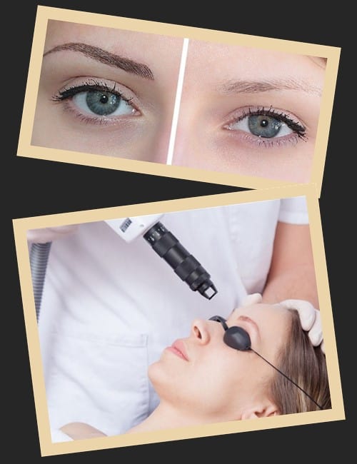 Процедура лазерного виведення перманентного макіяжу