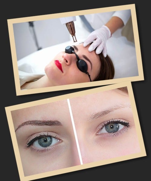 Видалення татуажу брів у Києві потребує серйозної підготовки.